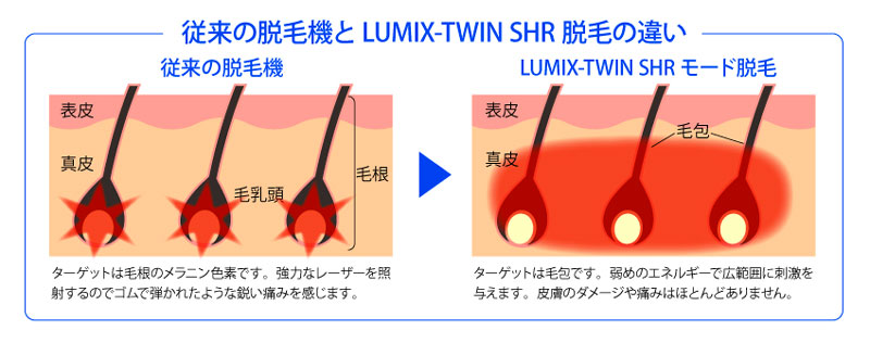 従来の脱毛方法との違い